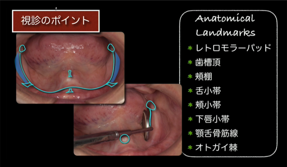 【人気動画】総義歯専門Dr.が語るベーシックテクニック/松丸悠一先生① Doctorbook academy