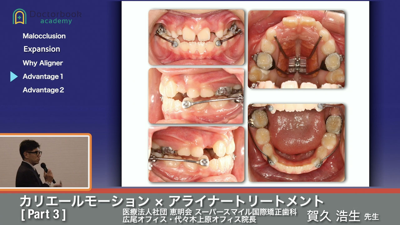 アライナー矯正治療 診断/治療計画/矯正治療/顎位整復治療 - 健康/医学