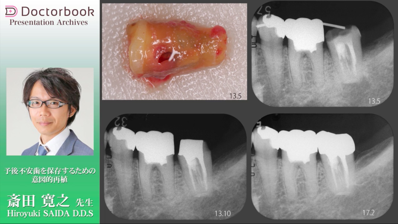 歯 の 再 植