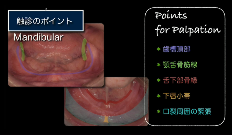 人気動画】総義歯専門Dr.が語るベーシックテクニック/松丸悠一先生①