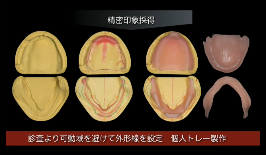 人気動画】総義歯専門Dr.が語るベーシックテクニック/松丸悠一