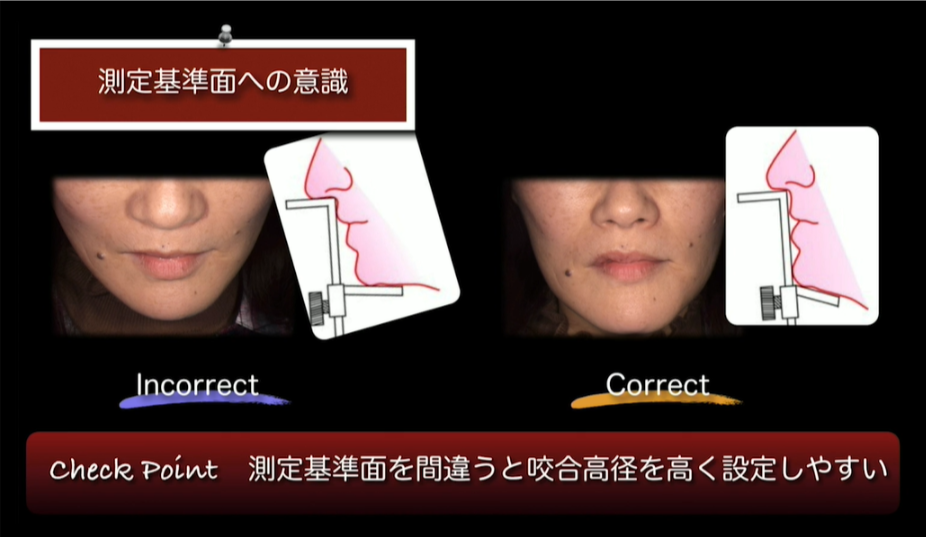 図解・咬合採得 81+9CXHoSXL._UF350,350_QL50_.jpg