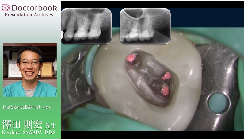 動画紹介］歯内療法をマスターしよう | Doctorbook academy (ドクター