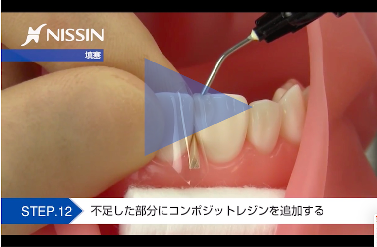 コンポジットレジン修復の基礎【動画でスキルアップ